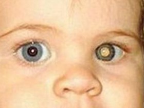 Одесские офтальмологи провели уникальную операцию ребенку