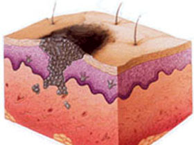 14 мая - День диагностики меланомы