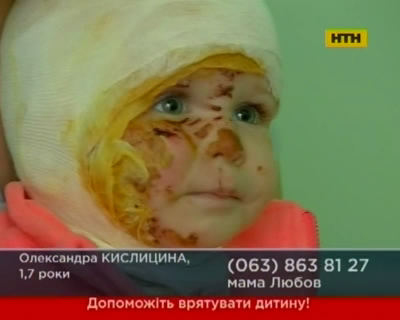 Маленькая беженка из Донецкой области нуждается в помощи