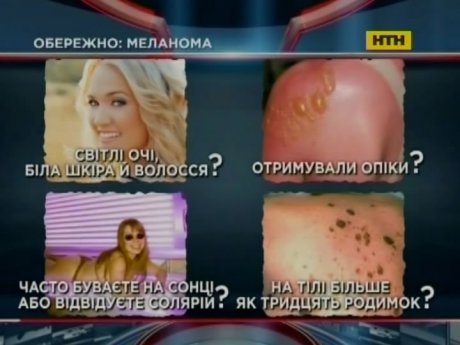 Киевлян предупредили об опасности меланомы