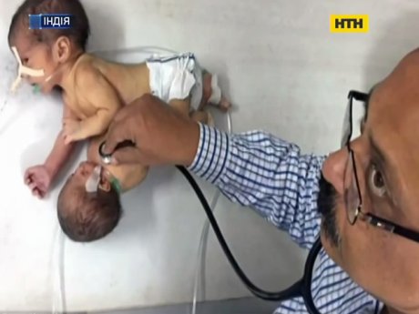 Дві голови та одна печінка - в Індії народилися сіамські близнюки