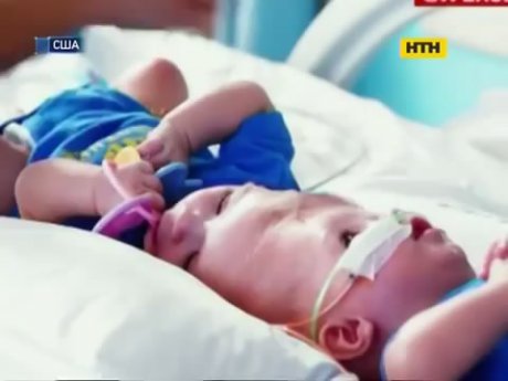 Унікальну операцію по роз'єднанню сіамських близнюків зробили у США