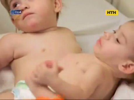 В США успешно прооперировали сиамских близнецов