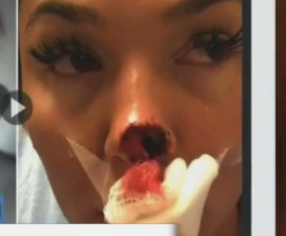 В Канаде парень откусил нос своей девушке из-за ревности