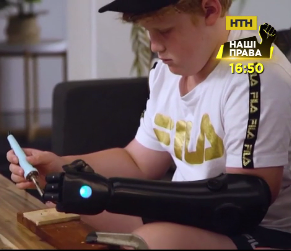 Ребенок, первым в Австралии, получил бионическую руку