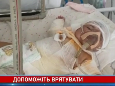В Кропивницком полуторагодовалый мальчик опрокинул на люльку с сестрой газовую плиту с горячим ужином