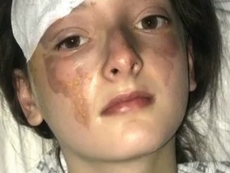 Британська дівчина отримала страшні опіки обличчя та ледь не втратила зір, коли намагалася приготувати собі вечерю за порадами із соцмереж