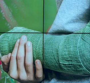 На Львовщине 6-летнему мальчику оторвало 4 пальца на руке из-за взрыва петарды