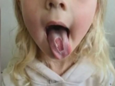 Жутких травм получила четырехлетняя девочка из Австрии, когда полакомилась конфетами