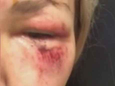 В Харьковской области женщина попала в реанимацию, после того как спустилась с горки на лыжном курорте